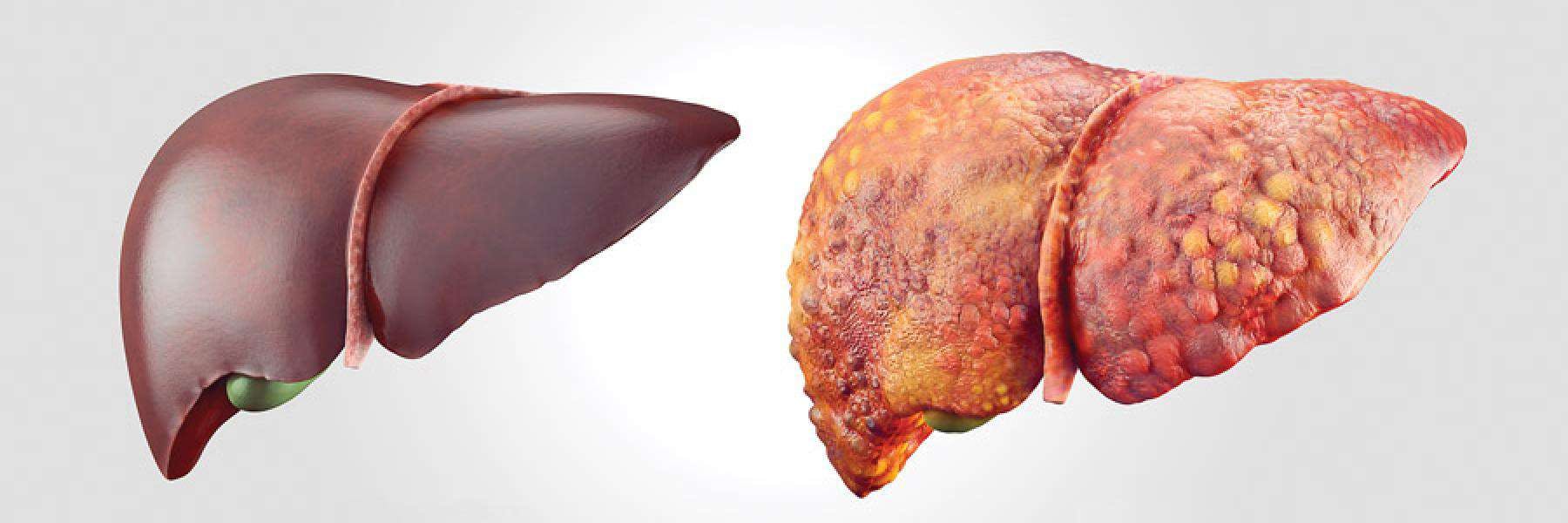 Your liver and hepatitis