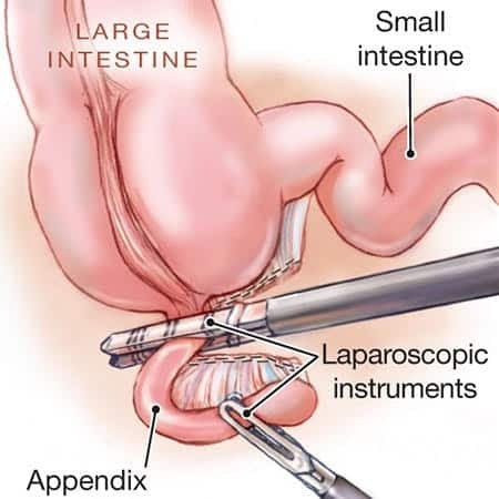 laparoscopic appendectomy recovery