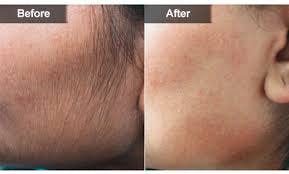 laser Hair Removal