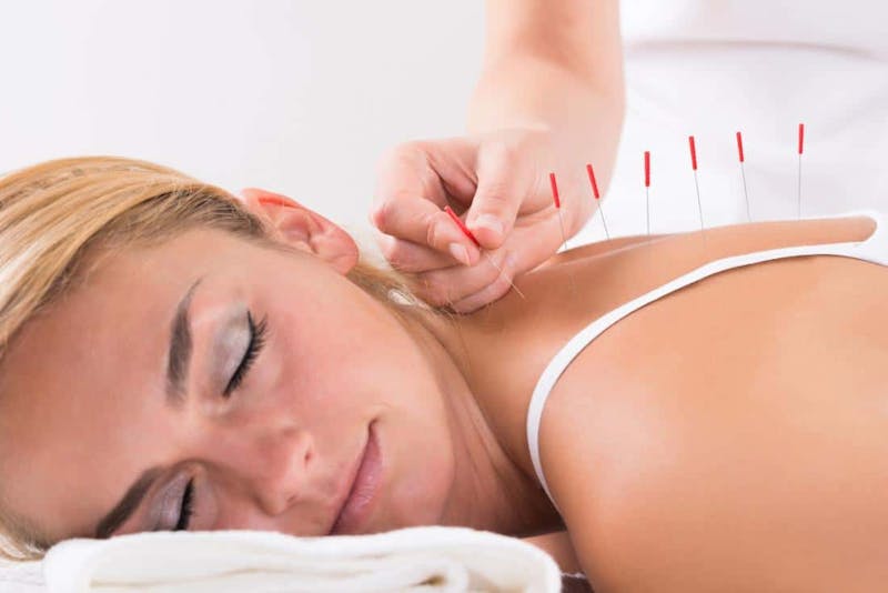 woman being treated with acupuncture